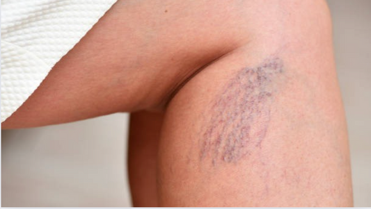 How Varicose Veins Stockings Can Improve Circulation