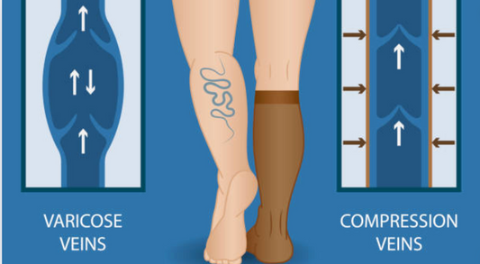 How Varicose Veins Stockings Support Leg Health
